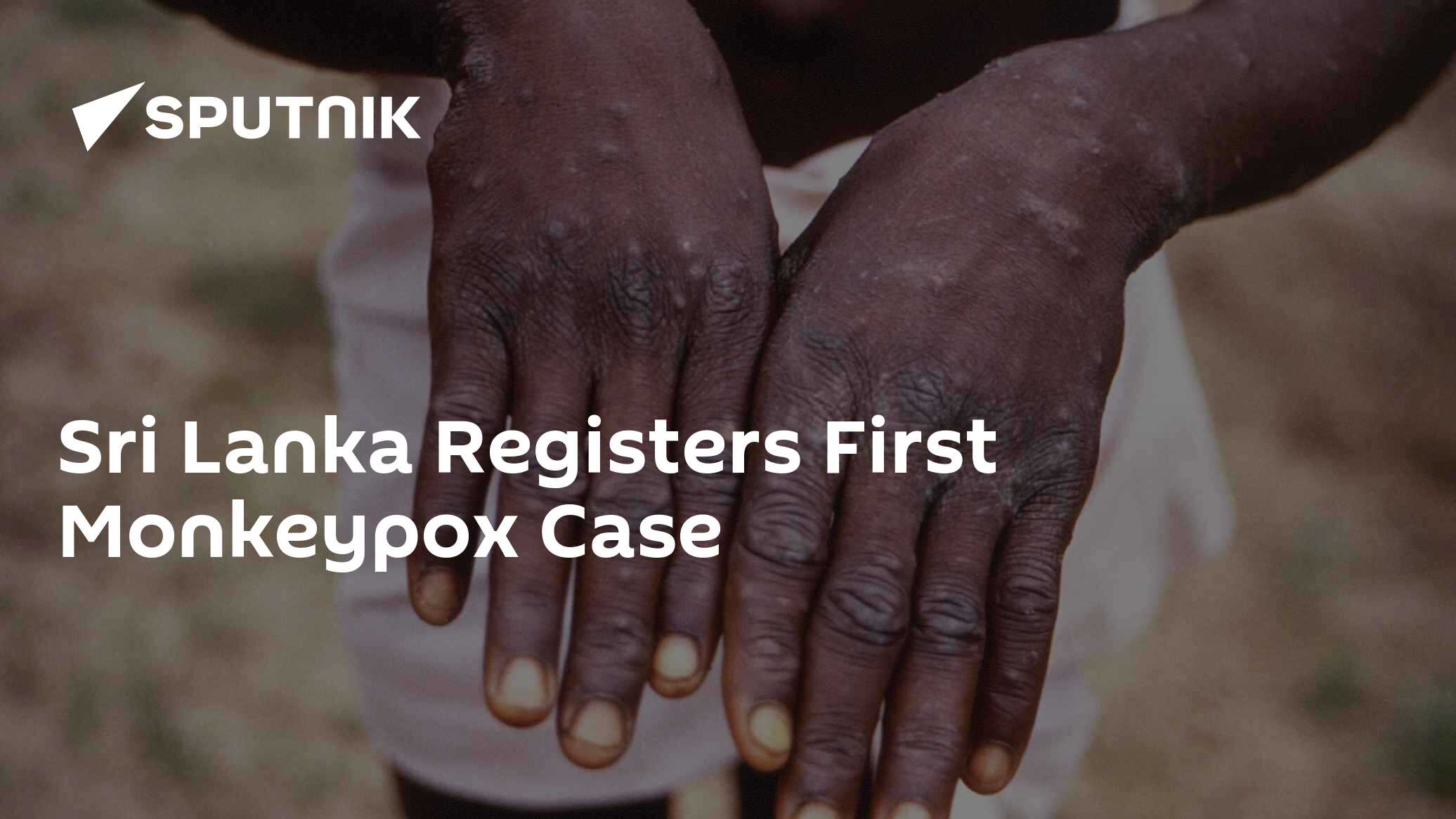 Sri Lanka Registers First Monkeypox Case - 04.11.2022, Sputnik ...