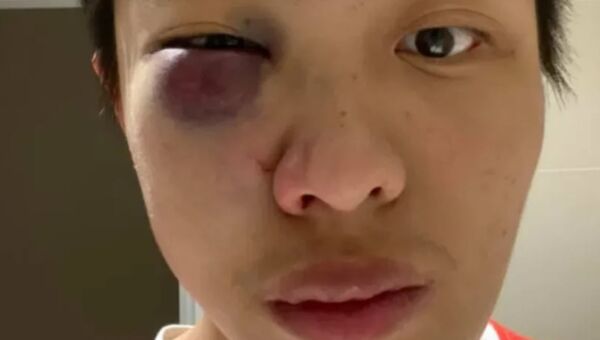 Jonathan Mok posted selfies of his injury on his Facebook page - Sputnik International
