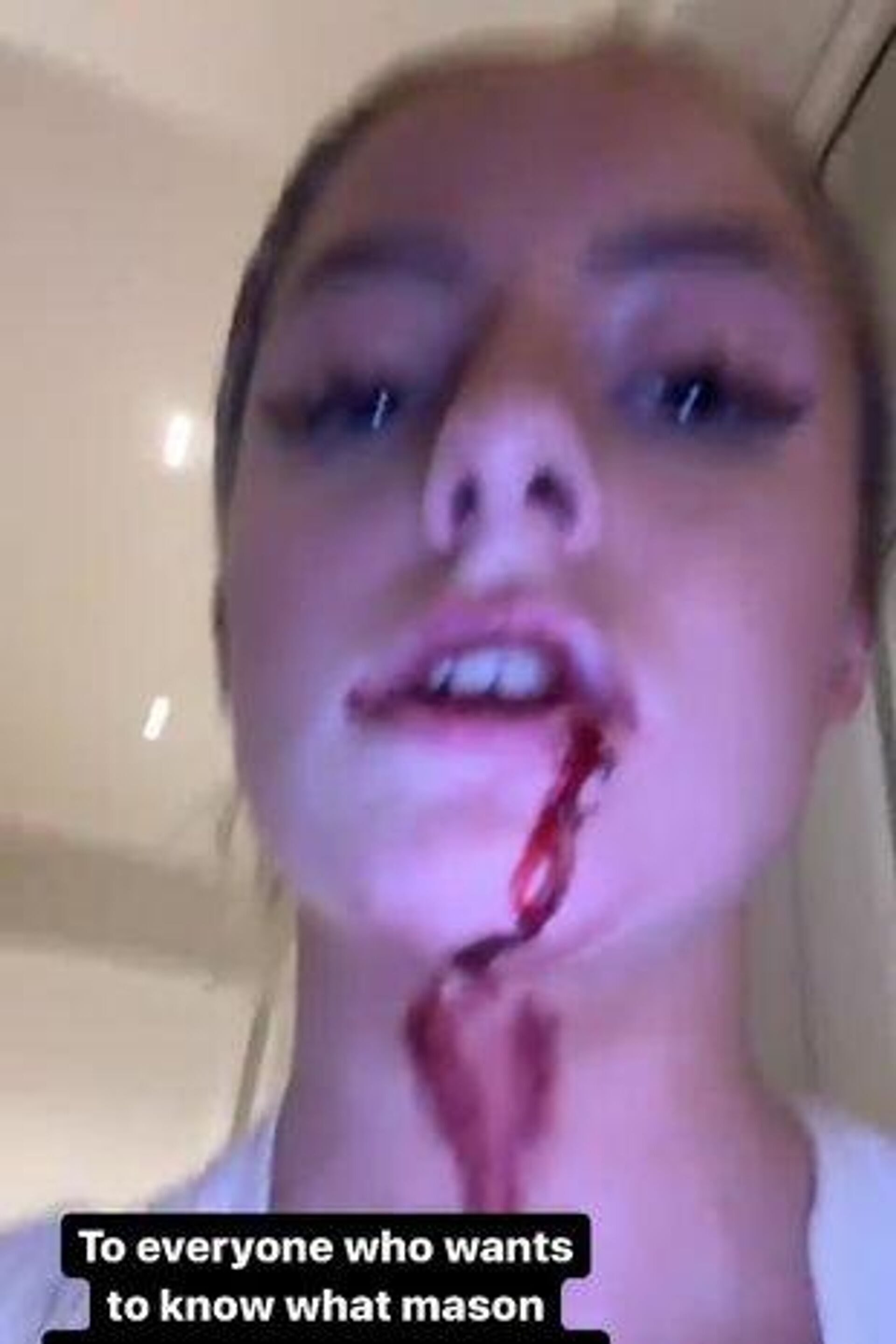 Screenshot of a deleted post published by Harriet Robson, depicting blood on her lip as she accuses her boyfriend Mason Greenwood of abuse. - Sputnik International, 1920, 30.01.2022