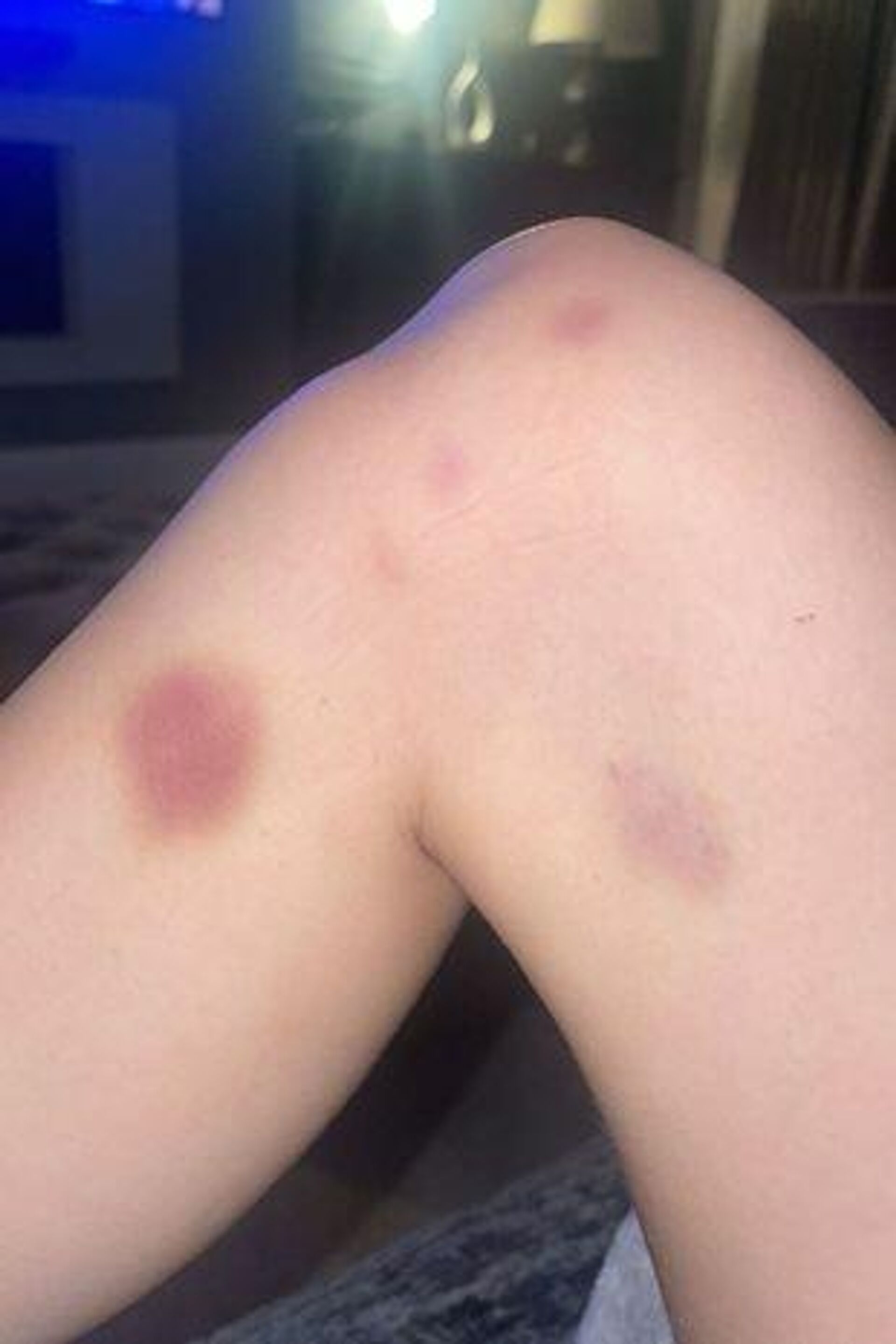 Screenshot of a deleted post published by Harriet Robson, depicting a bruise as she accuses her boyfriend Mason Greenwood of abuse. - Sputnik International, 1920, 30.01.2022