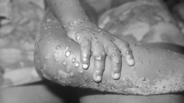 This image from 1971, depicts a view of the right hand and leg, of a 4 year-old female in Bondua, Grand Gedeh County, Liberia, which reveals numerous maculopapular monkeypox lesions, enabling you to see the similarity of these lesions to those of smallpox. - Sputnik International