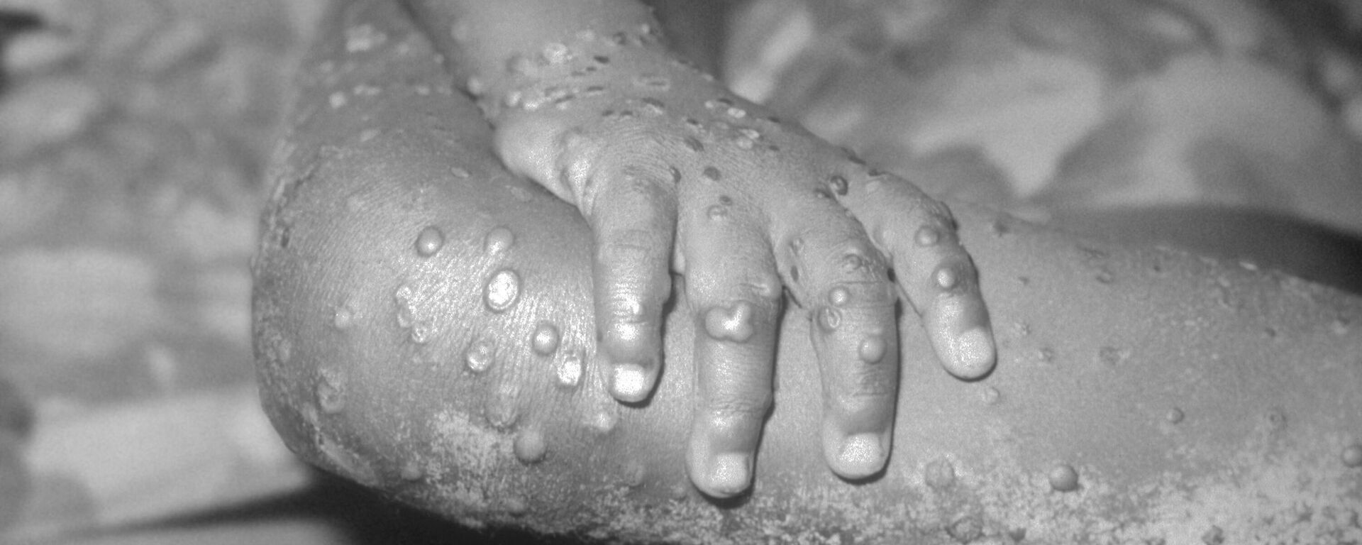 This image from 1971, depicts a view of the right hand and leg, of a 4 year-old female in Bondua, Grand Gedeh County, Liberia, which reveals numerous maculopapular monkeypox lesions, enabling you to see the similarity of these lesions to those of smallpox. - Sputnik International, 1920, 23.05.2022