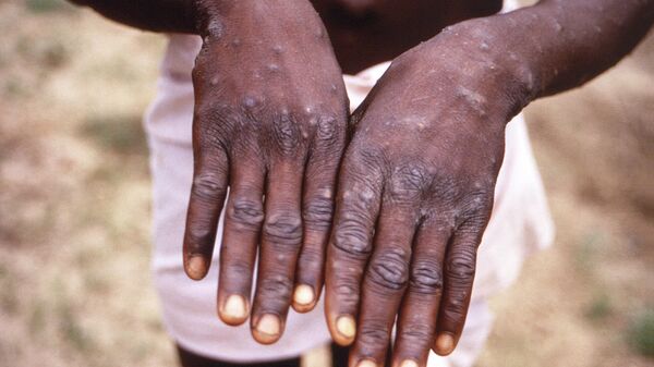 This 1997 image provided by the CDC during an investigation into an outbreak of monkeypox, which took place in the Democratic Republic of the Congo (DRC), formerly Zaire, and depicts the dorsal surfaces of the hands of a monkeypox case patient, who was displaying the appearance of the characteristic rash during its recuperative stage. The World Health Organization is convening its emergency committee  on Thursday, July 21, 2022 to consider for the second time within weeks whether the expanding outbreak of monkeypox should be declared a global crisis.  - Sputnik International