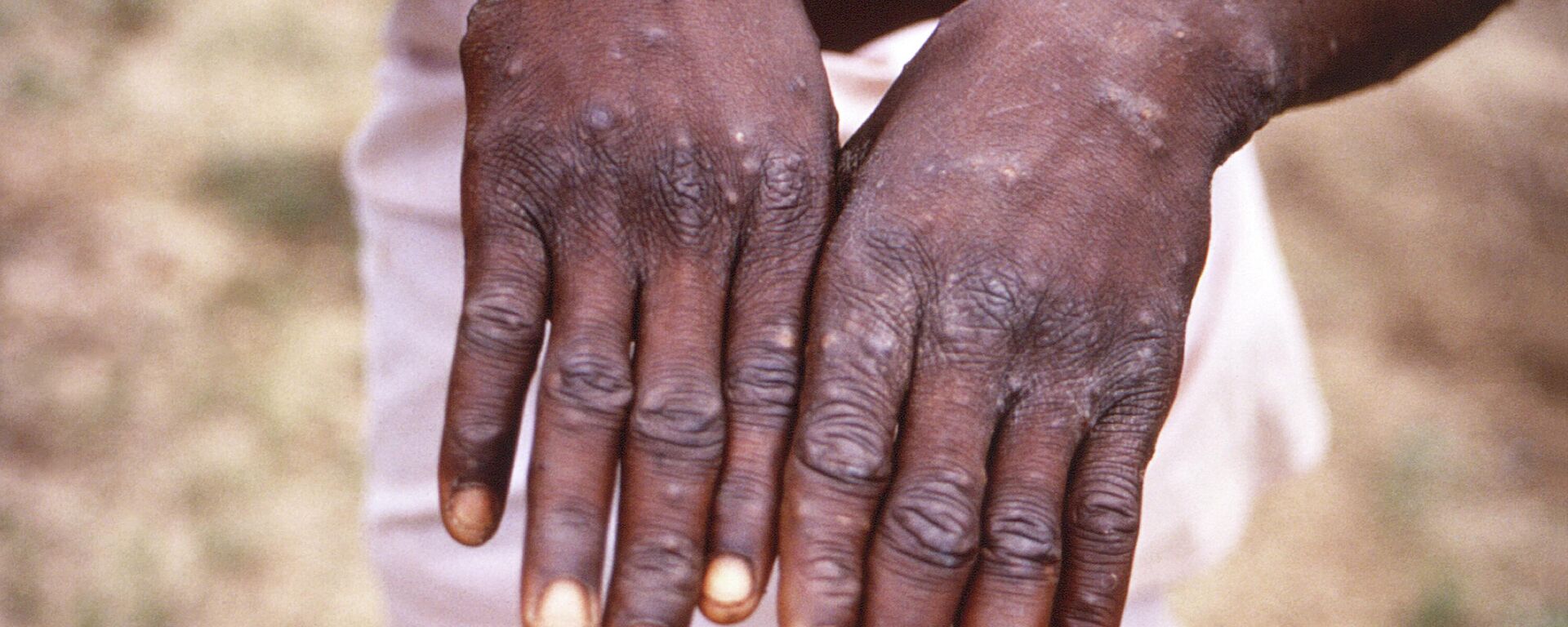 This 1997 image provided by the CDC during an investigation into an outbreak of monkeypox, which took place in the Democratic Republic of the Congo (DRC), formerly Zaire, and depicts the dorsal surfaces of the hands of a monkeypox case patient, who was displaying the appearance of the characteristic rash during its recuperative stage. The World Health Organization is convening its emergency committee  on Thursday, July 21, 2022 to consider for the second time within weeks whether the expanding outbreak of monkeypox should be declared a global crisis.  - Sputnik International, 1920, 19.09.2022