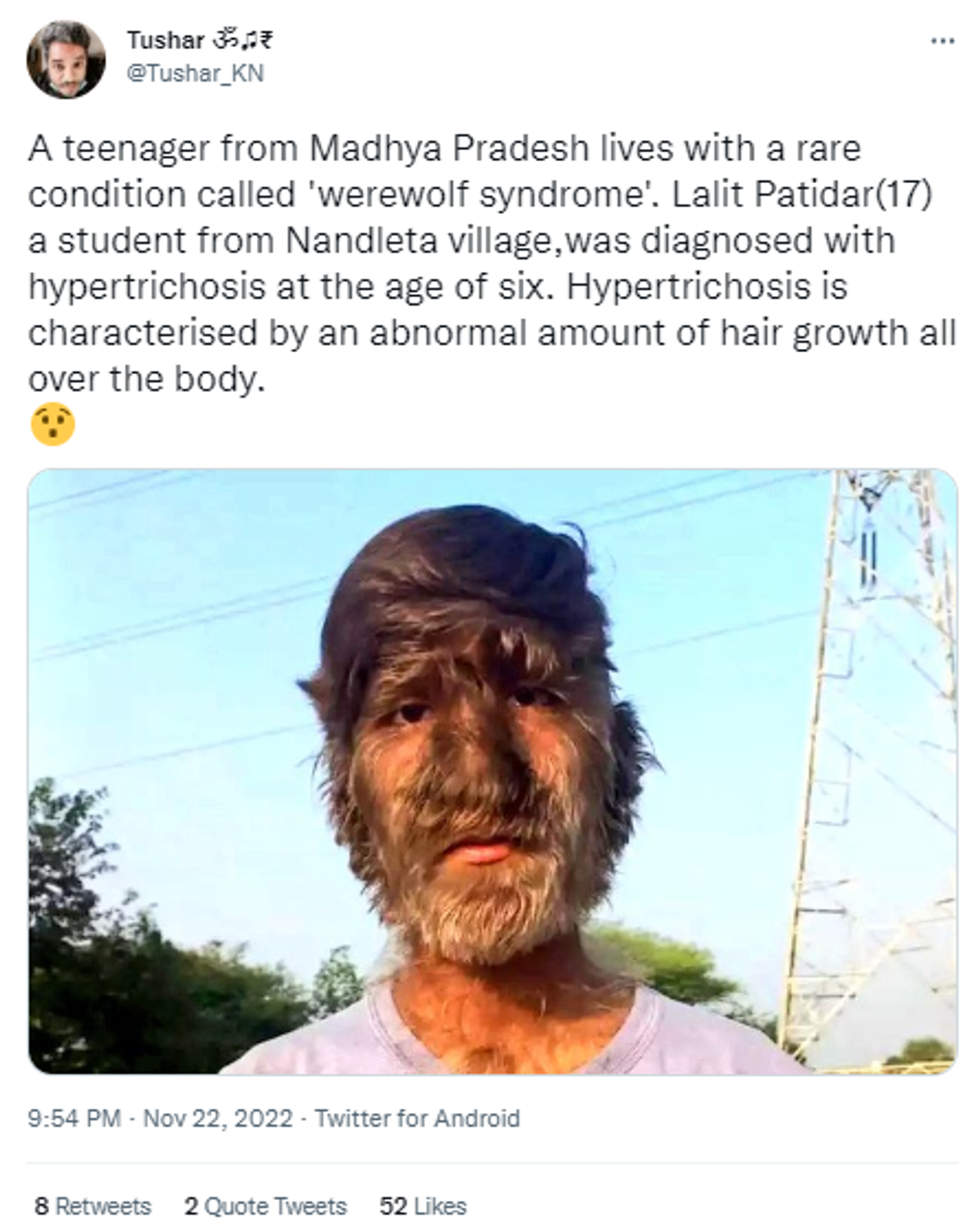 17-year-old boy, Lalit Patidar, from India's Madhya Pradesh state diagnosed with a rare disorder - Werewolf Syndrome - Sputnik International, 1920, 23.11.2022