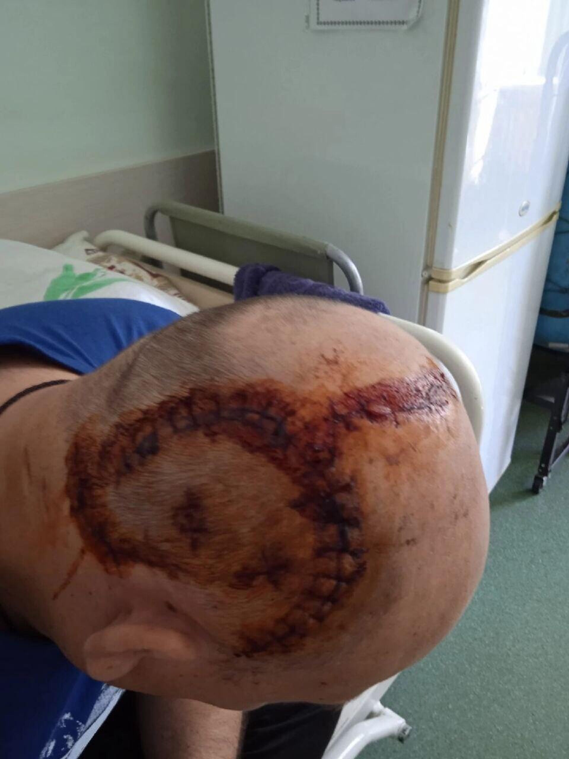 Signs of beatings and torture endured by Viktor, a serviceman in the Donetsk People's Republic (DPR) forces, when a prisoner of Ukraine's military and ultra-nationalists. - Sputnik International, 1920, 20.05.2023