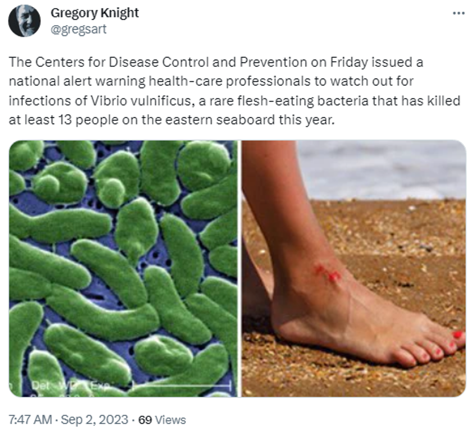 X Screenshot featuring images of flesh-eating Vibrio vulnificus bacteria amid cases discovered in US. - Sputnik International, 1920, 02.09.2023