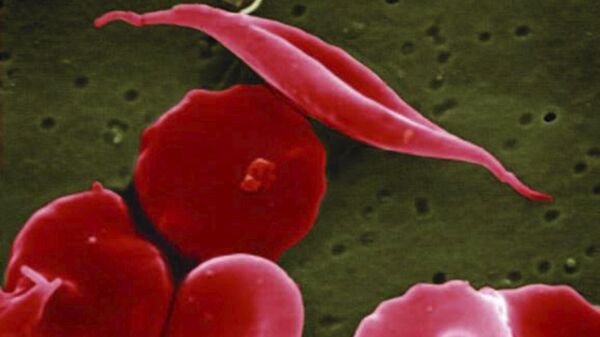 This electron microscope image provided by the National Institutes of Health in 2016 shows a blood cell altered by sickle cell disease, top. - Sputnik International