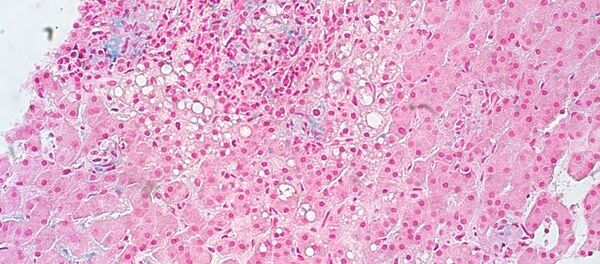 MAC granulomatous hepatitis - Sputnik International