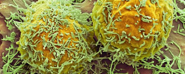 Liver cancer Liver cancer - Sputnik International