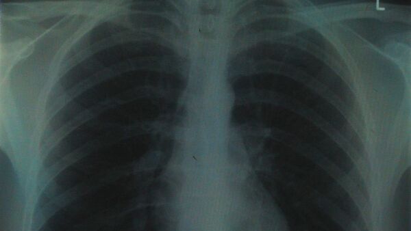 chest x-ray half - Sputnik International