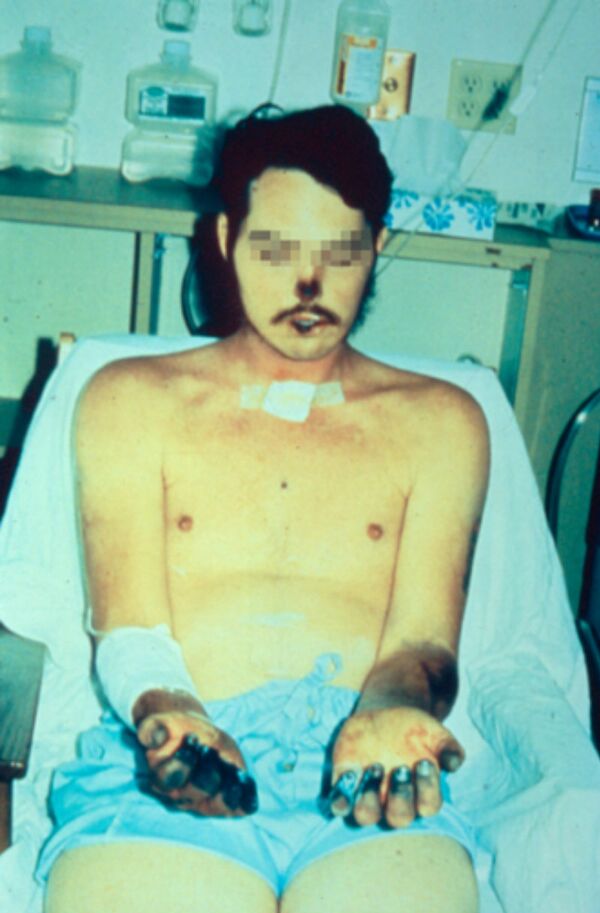 Acral necrosis of the nose, the lips, and the fingers and residual ecchymoses over both forearms in a patient recovering from bubonic plague that disseminated to the blood and the lungs. - Sputnik International