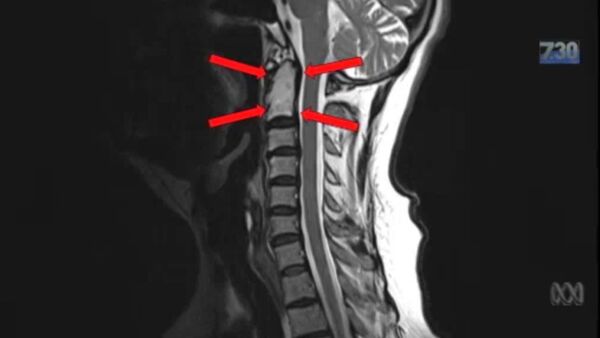 X-ray photograph of spinal cord tumor - Sputnik International