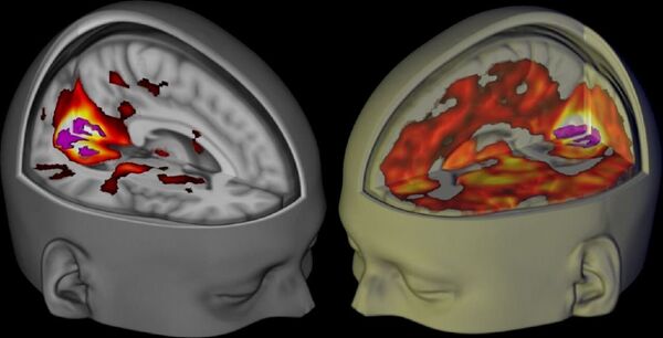 Handout shows the brains of subjects lying awake with their eyes closed, under a placebo and the drug LSD, when being examined using functional MRI. Handout shows the brains of subjects lying awake with their eyes closed, under a placebo and the drug LSD, when being examined using functional MRI. - Sputnik International