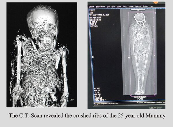 The C. T. scan of the Mummy The C. T. scan of the Mummy - Sputnik International