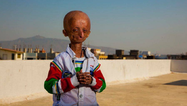 Indian teenager suffering from progeria passes away - Sputnik International