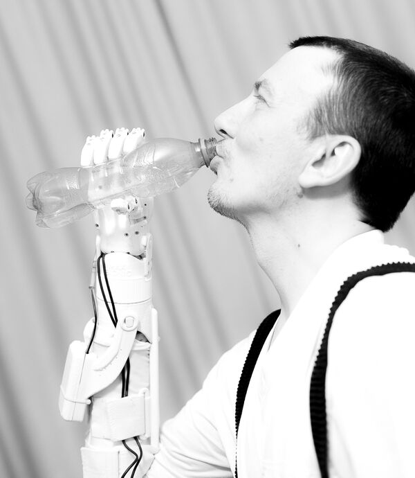 A patient with the MaxBionic prosthesis A patient with the MaxBionic prosthesis - Sputnik International