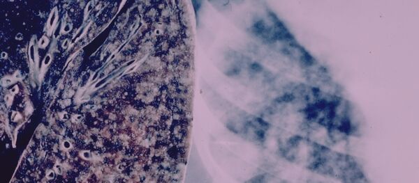Tuberculosis - Sputnik International