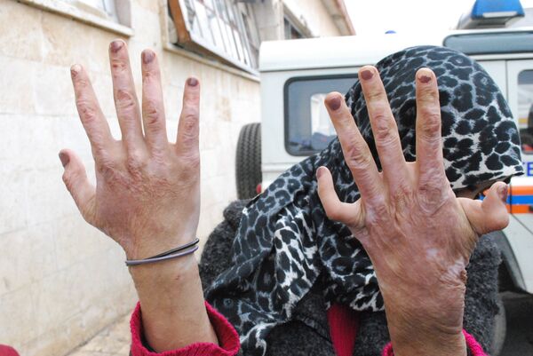 Woman in Aleppo shows her burnt hands - Sputnik International