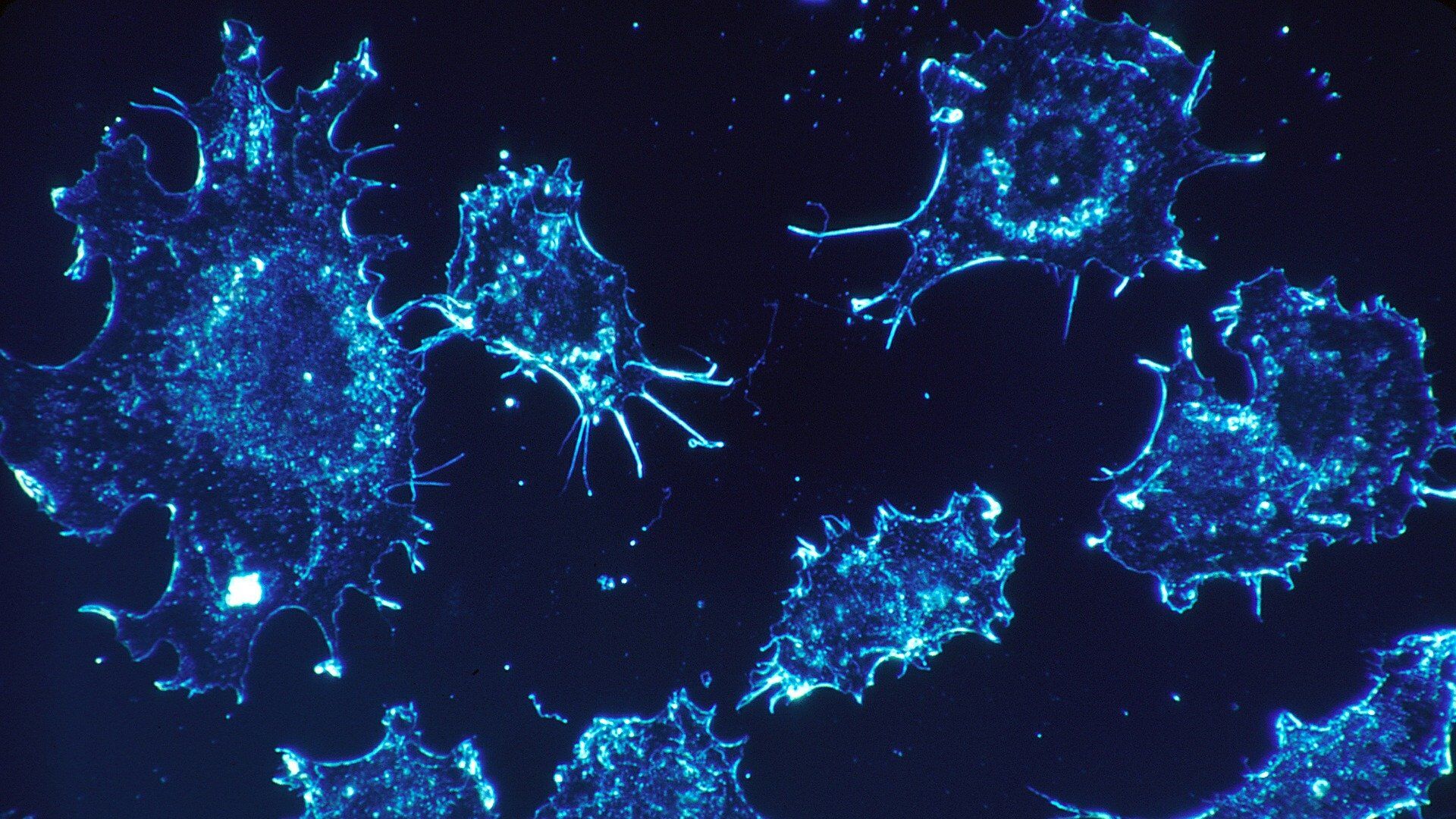 Cancer cells  - Sputnik International, 1920, 08.07.2021