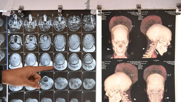 Indian doctor Ramanuj Kabra points to brain scans of Santlal Pal, 31, at the BYL Nair hospital in Mumbai on February 22, 2018 - Sputnik International