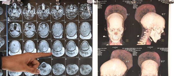 Indian doctor Ramanuj Kabra points to brain scans of Santlal Pal, 31, at the BYL Nair hospital in Mumbai on February 22, 2018 - Sputnik International