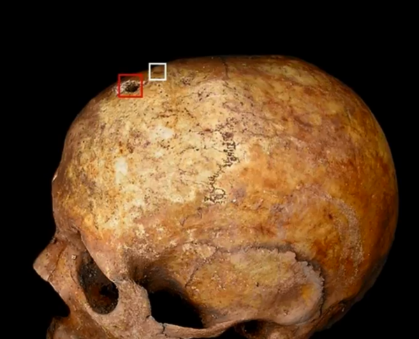 Archaeologists speculate hole found in medieval woman's skull linked to trepanation, a brain surgery technique dating back to the Middle Ages. Archaeologists speculate hole found in medieval woman's skull linked to trepanation, a brain surgery technique dating back to the Middle Ages. - Sputnik International