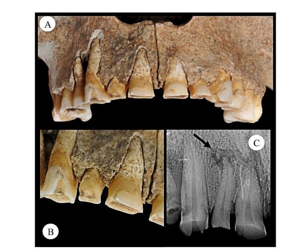 Buccal view of surface wear of the RI2 (A and B); type and orientation of wear is a clear indication of the extra-masticatory use of the tooth, which shows a crown significantly reduced (if not obliterated) in comparison to the left second incisor. (C) X-ray of the right upper second incisor tooth, notice the periapical lesion located at the proximal end of the root, T US 380. The lighter col - oured bone around the margins of the exposed tooth roots RI2 is the result of post-mortem damage Buccal view of surface wear of the RI2 (A and B); type and orientation of wear is a clear indication of the extra-masticatory use of the tooth, which shows a crown significantly reduced (if not obliterated) in comparison to the left second incisor. (C) X-ray of the right upper second incisor tooth, notice the periapical lesion located at the proximal end of the root, T US 380. The lighter col - oured bone around the margins of the exposed tooth roots RI2 is the result of post-mortem damage - Sputnik International