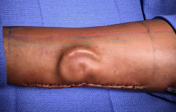 US Army surgeons give soldier new ear after growing it inside her arm - Sputnik International