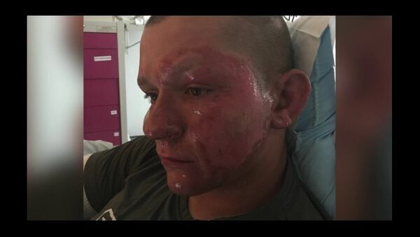 Spotsylvania Teen Alex Childress, Hospitalized With Burns From Giant Hogweed Plant - Sputnik International