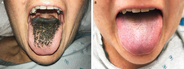 Missouri woman contracts Black Hairy Tongue after having a bad reaction to antibiotics. Image 'A' shows the discoloration observed by officials and image 'B' shows the patient's tongue after minocycline, the antibiotic the caused the condition, was stopped. - Sputnik International