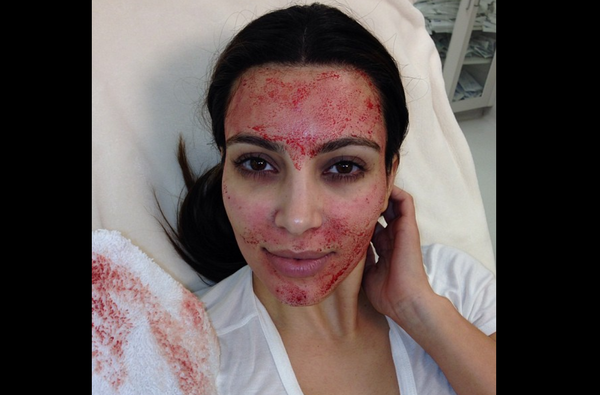 Kim Kardashian, showing off 'vampire facial' in 2013 Kim Kardashian, showing off 'vampire facial' in 2013 - Sputnik International