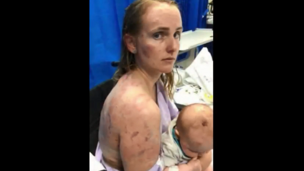 Australian mom suffers severe bruising after shielding baby from hailstorm in Queensland - Sputnik International
