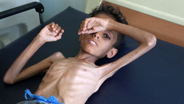 Yemeni boy Ghazi Ali bin Ali, 10, suffering from severe malnutrition lies on a bed at a hospital in Jabal Habashi on the outskirts of the city of Taiz, on October 30, 2018 - Sputnik International