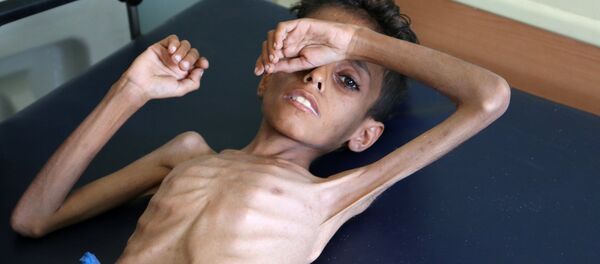 Yemeni boy Ghazi Ali bin Ali, 10, suffering from severe malnutrition lies on a bed at a hospital in Jabal Habashi on the outskirts of the city of Taiz, on October 30, 2018 - Sputnik International