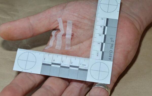 A police officer received this injury as he grappled with Mohiussunnath Chowdhury, who was carrying a samurai sword A police officer received this injury as he grappled with Mohiussunnath Chowdhury, who was carrying a samurai sword - Sputnik International