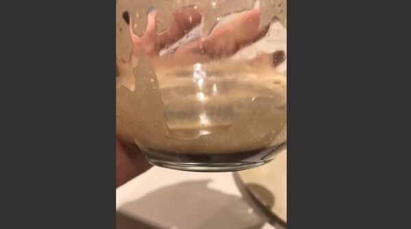 Kim Kardashian is treating her psoriasis - Sputnik International