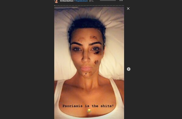Kim Kardashian psoriasis - Sputnik International