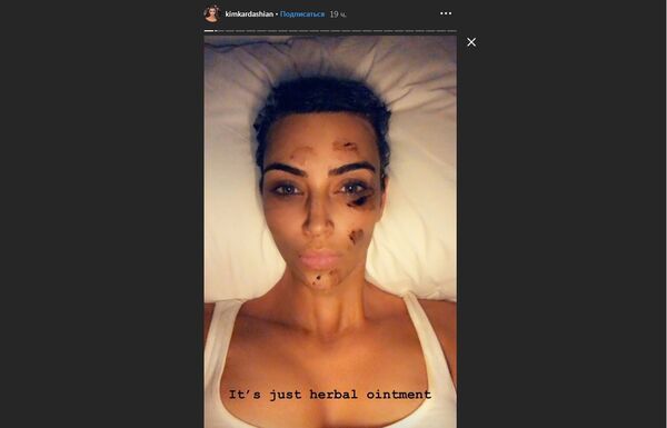 Kim Kardashian psoriasis - Sputnik International