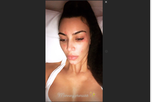 Kim Kardashian psoriasis Kim Kardashian psoriasis - Sputnik International