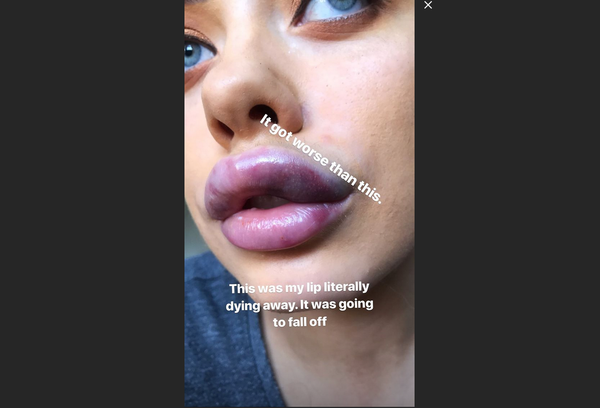 Cassidy Valentine's botched lip job - Sputnik International