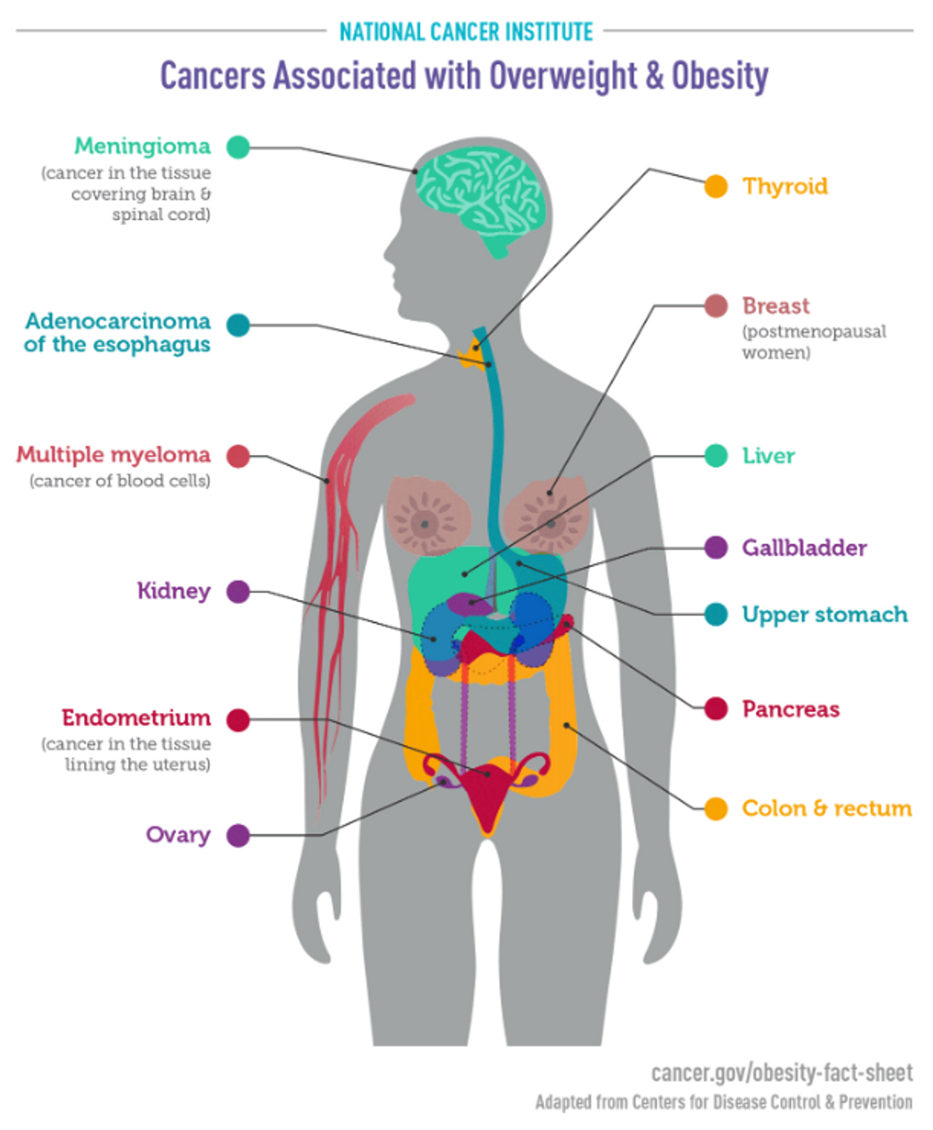 Cancers Associated with Overweight and Obesity infographic from the US National Cancer Institute  - Sputnik International, 1920, 08.04.2022