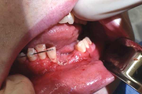 ‘He Could’ve Been Dead’: Vape Pen Explosion Leaves US Teen’s Jaw Shattered, Cracked (GRAPHIC PHOTO) - Sputnik International