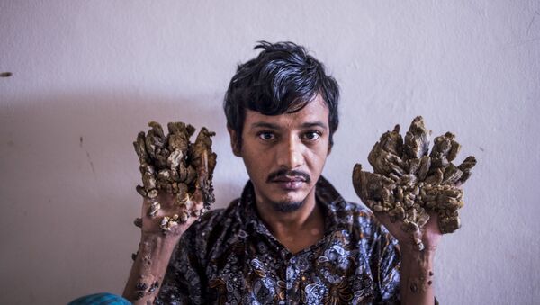 Abul Bajandar , 28, dubbed Tree Man for massive bark-like warts on his hands and feet, sits at Dhaka Medical College Hospital in Dhaka on June 24, 2019. - Frustrated by worsening condition, a Bangladeshi father dubbed “Tree Man” for the bark-like growths on his body said on June 24 he wants to amputate his hands to get relief from unbearable pain. (Photo by Munir UZ ZAMAN / AFP) - Sputnik International
