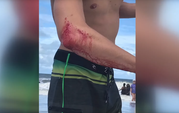 US Man Attacked by Shark Forgoes Hospital, Rushes Off to Local Bar (Photo) US Man Attacked by Shark Forgoes Hospital, Rushes Off to Local Bar (Photo) - Sputnik International