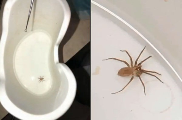 Venomous Brown Recluse Spider Discovered Inside US Woman’s Ear (Photo) Venomous Brown Recluse Spider Discovered Inside US Woman’s Ear (Photo) - Sputnik International