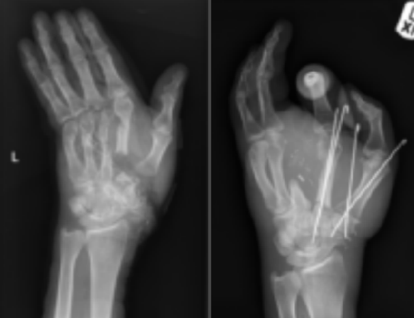 Graphic Photo: UK Man’s Hand Sliced by Electric Saw Reattached After Hours-Long Operation - Sputnik International