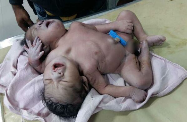 Indian Woman Gives Birth to Boy with Two Heads and Three Hands - Photos - Sputnik International