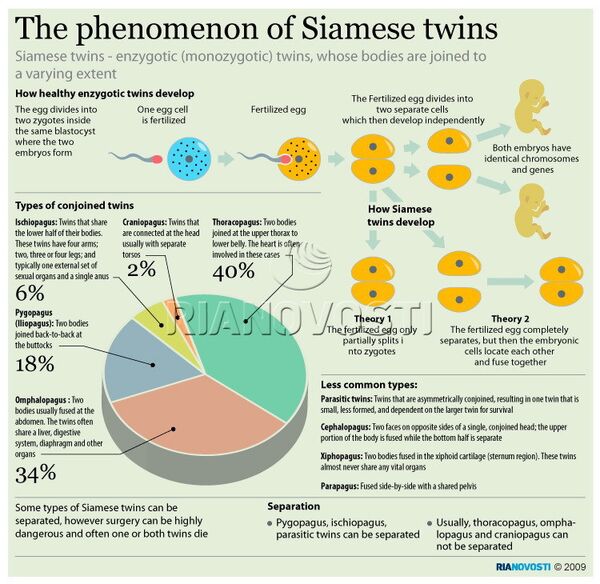 The phenomenon of Siamese twins - Sputnik International