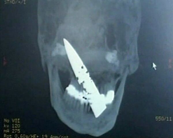 Chinese man has knife in his skull for four year - Sputnik International